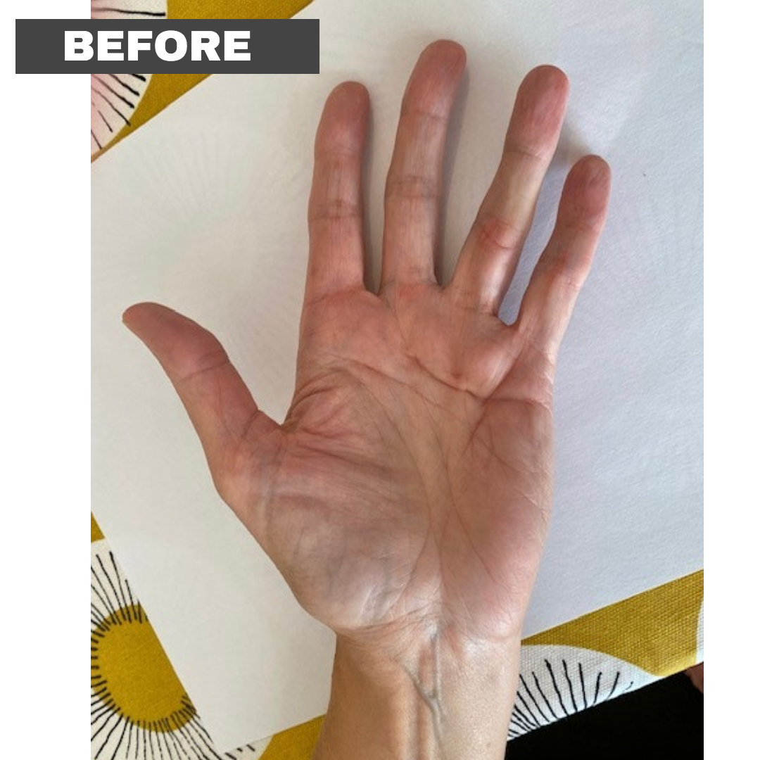 Dupuytrens Contracture Occupational Therapist Assessment - Before and After 6 weeks of Deep Oscillation Treatment